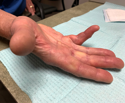 Dupuytren's Disease