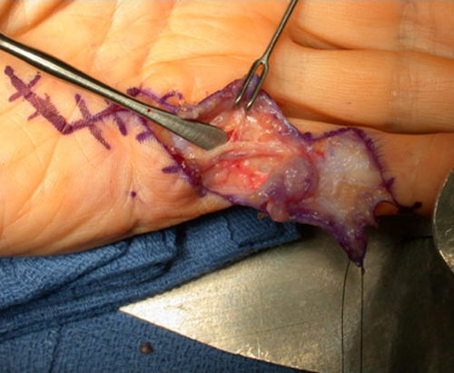 Fasciectomy