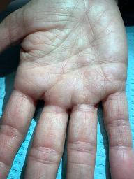 Palmar Fibromatosis