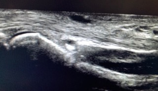 Ultrasound of a Palmar Fascial Cyst